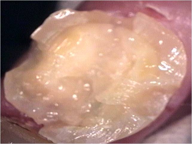 Fixed orthodontic retainers made with Ribbond are very esthetic, comfortable, and strong.